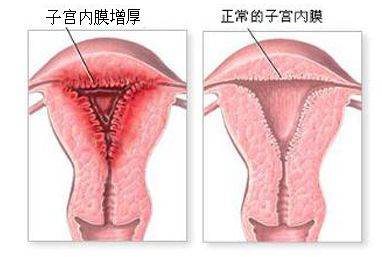 子宫内膜厚度、增厚.jpg