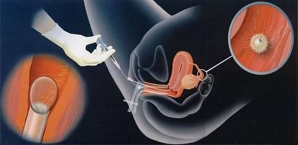 子宫内膜异位症影响怀孕吗