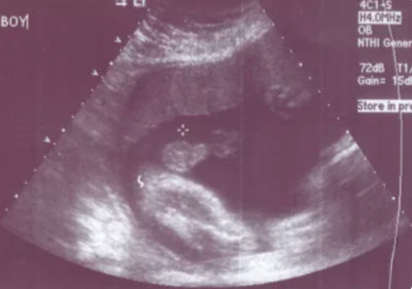 泰国试管婴儿：胎心率能判断生男生女吗