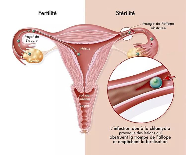 子宫内膜异位症是什么意思 影响怀孕吗